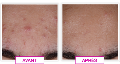 Vue du front avant et après l'emploi du masque de lumiothérapie antiacné NEUTROGENA®