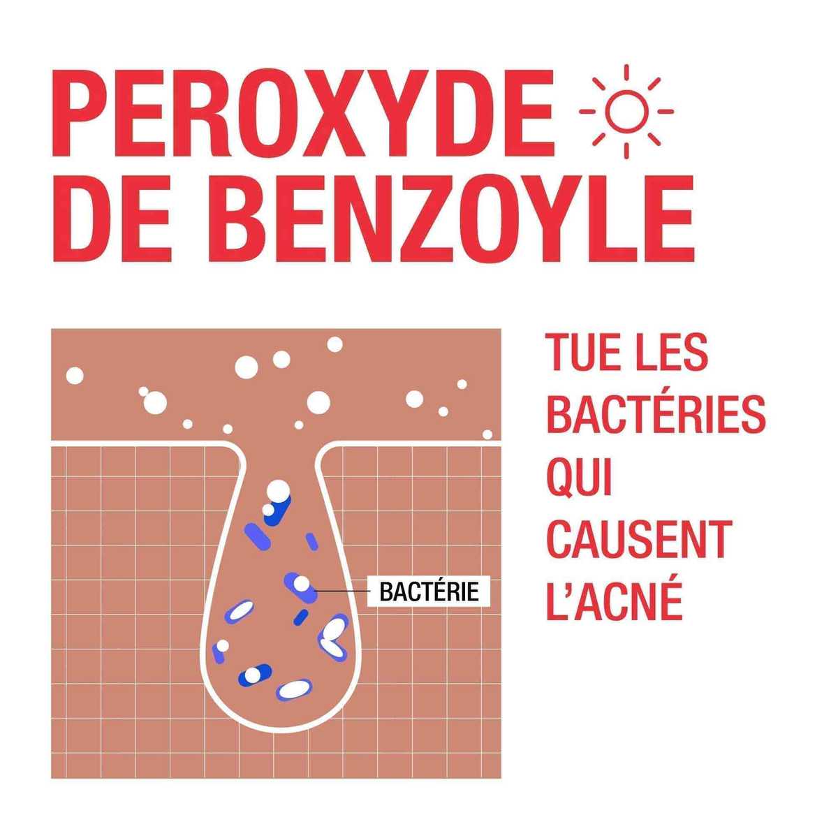 Image montrant comment le peroxyde de benzoyle tue les bactéries responsables de l'acné